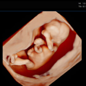 Samsung Hera W10 sets a new benchmark for 3D/4D elective ultrasound studios—see image quality, AI features, ROI, and why it rivals the GE E10 in every category.