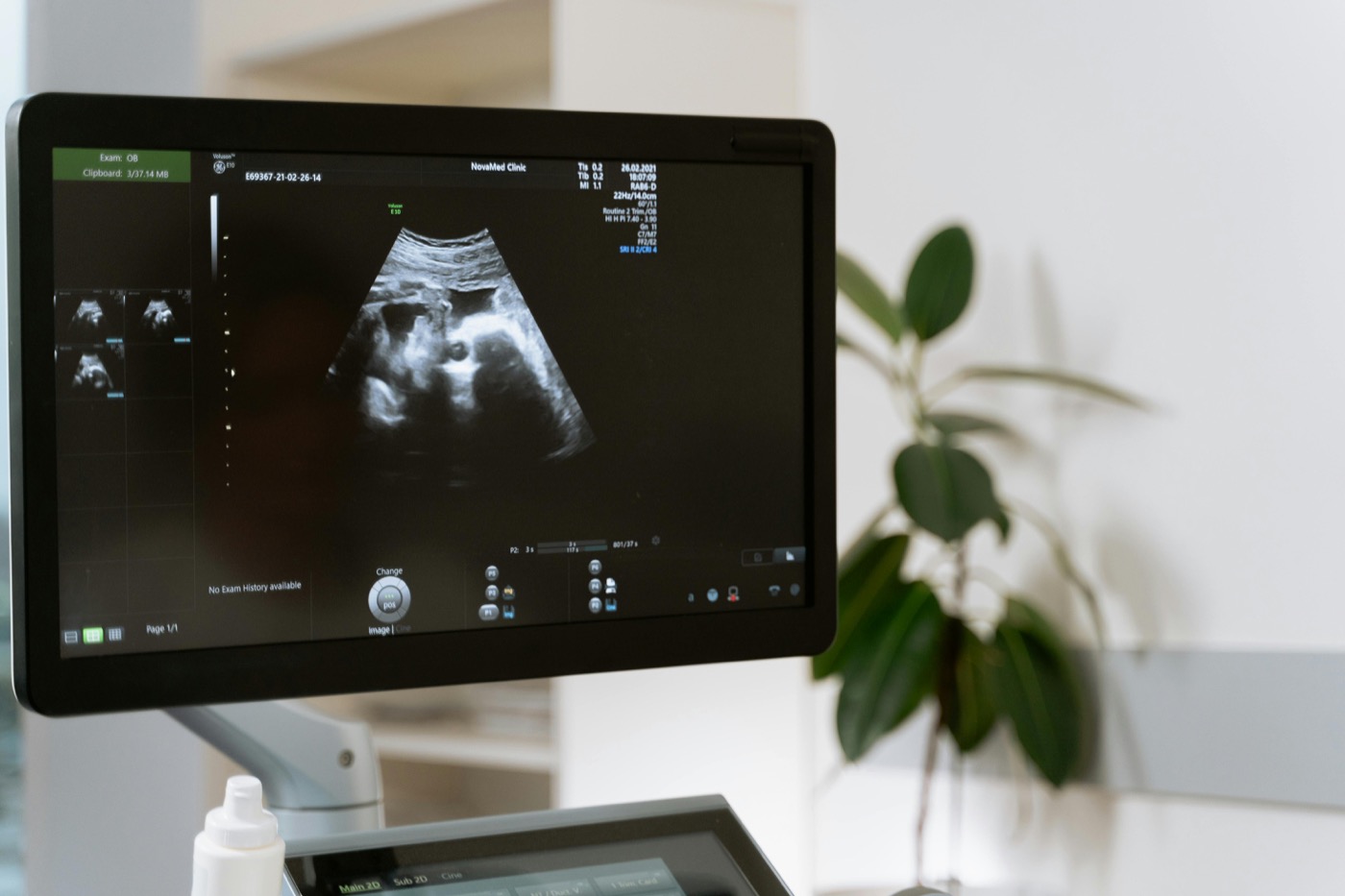 Ultrasound machine monitor showing 2D baby scan